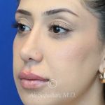 after lip filler left angle view female patient case 20448