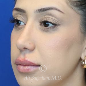 after lip filler left angle view female patient case 20448