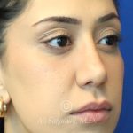 before lip filler right angle view female patient case 20448