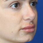 after lip filler right angle view female patient case 20455