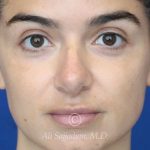 before lip filler front view female patient case 20455