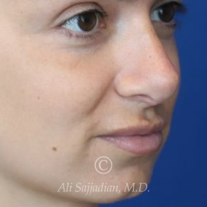 before lip filler right angle view female patient case 20455
