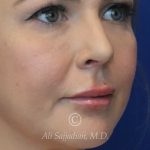 after lip filler right angle view female patient case 20463