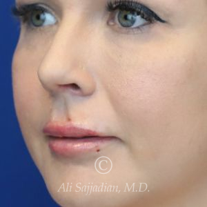 after lip filler left angle view female patient case 20463