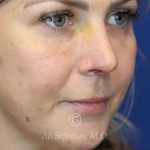 before lip filler right angle view female patient case 20463