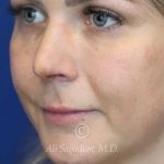 before lip filler left angle view female patient case 20463