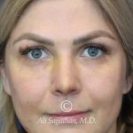 before lip filler front view female patient case 20463