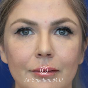 after lip filler front view female patient case 20463