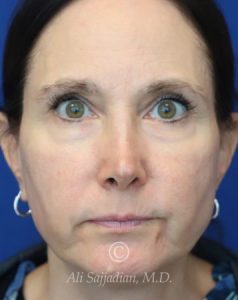 before chin and jawline filler front view female patient case 20832