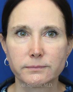 after chin and jawline filler front view female patient case 20832