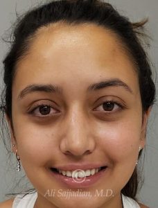 after gummy smile procedure front view female patient case 20828