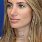 after rhinoplasty left angle view female patient case 20744