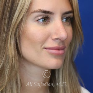 after rhinoplasty right angle view female patient case 20744