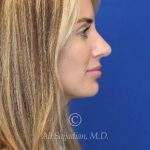 after rhinoplasty right side view female patient case 20744
