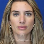 after rhinoplasty front view female patient case 20744