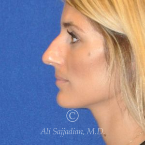 before rhinoplasty left side view female patient case 20744