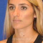 before rhinoplasty left angle view female patient case 20744