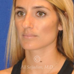 before rhinoplasty left angle view female patient case 20744