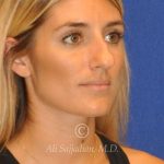 before rhinoplasty right angle view female patient case 20744
