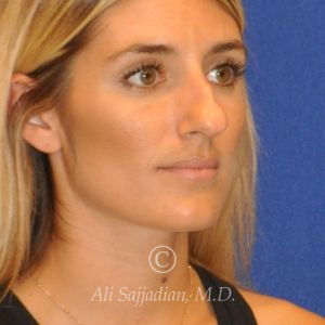 before rhinoplasty right angle view female patient case 20744