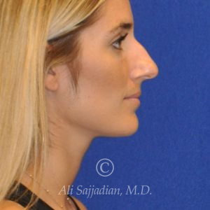 before rhinoplasty right side view female patient case 20744