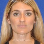 before rhinoplasty front view female patient case 20744