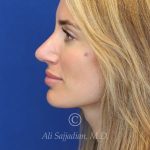 after rhinoplasty left side view female patient case 20744