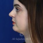 after rhinoplasty left side view female patient case 20755