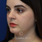 after rhinoplasty left angle view female patient case 20755