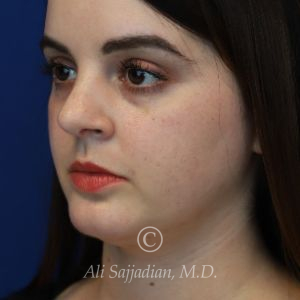 after rhinoplasty left angle view female patient case 20755