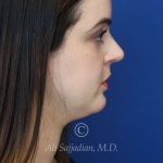 after rhinoplasty right side view female patient case 20755