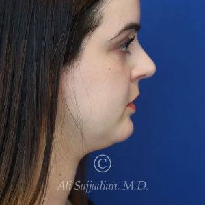 after rhinoplasty right side view female patient case 20755