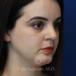 after rhinoplasty right angle view female patient case 20755
