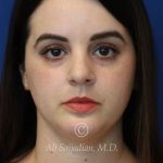 after rhinoplasty front view female patient case 20755