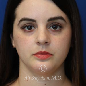 after rhinoplasty front view female patient case 20755