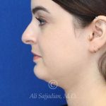 before rhinoplasty left side view female patient case 20755