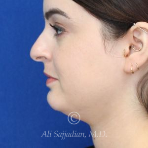 before rhinoplasty left side view female patient case 20755