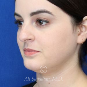 before rhinoplasty left angle view female patient case 20755