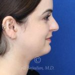 before rhinoplasty right side view female patient case 20755