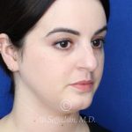 before rhinoplasty right angle view female patient case 20755