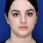 before rhinoplasty front view female patient case 20755