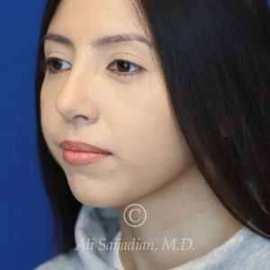 after rhinoplasty left angle view female patient case 20766
