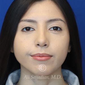 after rhinoplasty front view female patient case 20766