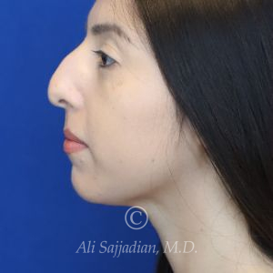 before rhinoplasty left side view female patient case 20766