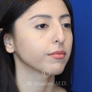 before rhinoplasty right angle view female patient case 20766