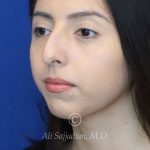 before rhinoplasty left angle view female patient case 20766