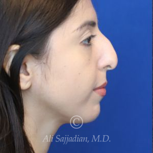 before rhinoplasty right side view female patient case 20766