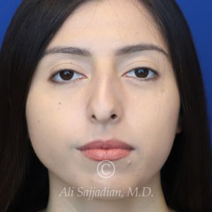 before rhinoplasty front view female patient case 20766