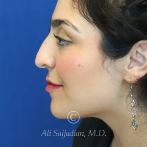 before rhinoplasty left side view female patient case 20777