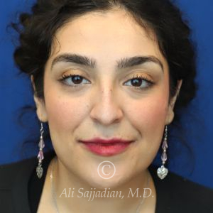 before rhinoplasty front view female patient case 20777